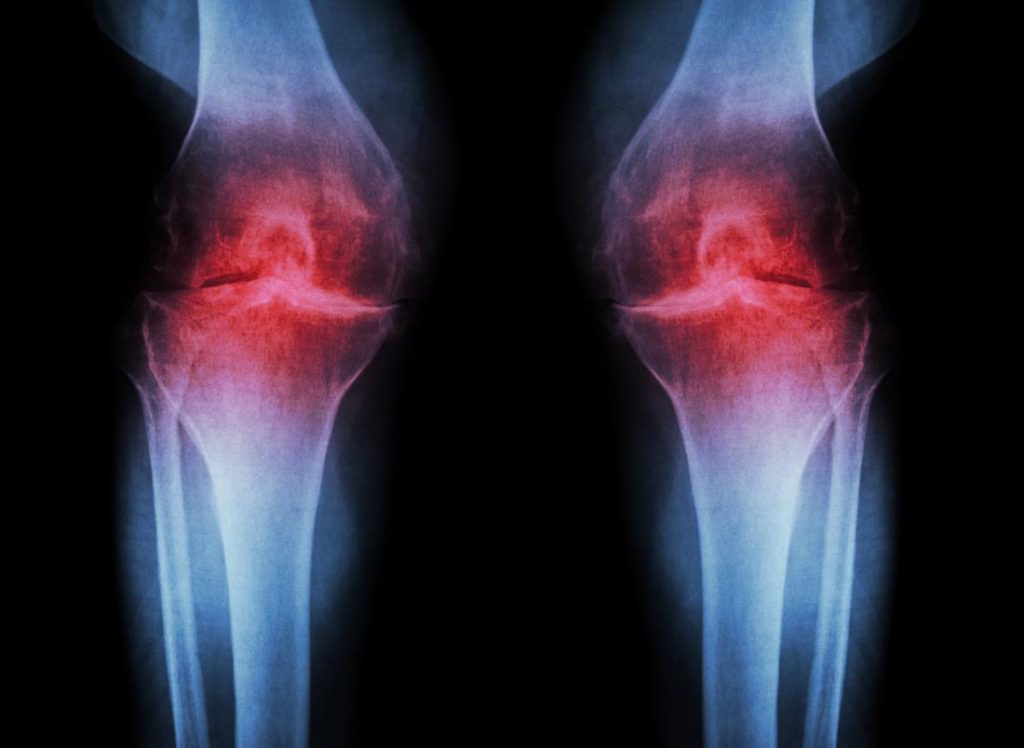 Tratamiento de la Artrosis El principal objetivo del tratamiento de la artrosis es mejorar el dolor y la incapacidad funcional sin provocar efectos secundarios
