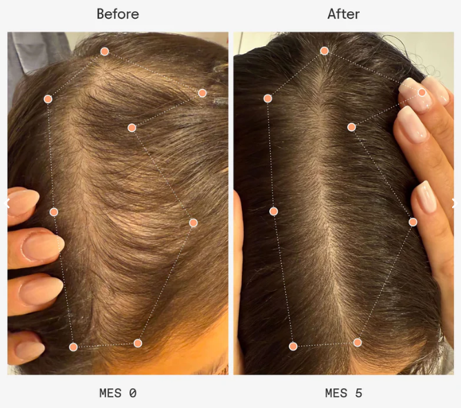 Comprar Olistic Women en Gran Farmacia Andorra. Para mujeres de 18 a 45 años que quieren frenar la caída capilar y potenciar un cabello más sano, fuerte y con mayor crecimiento. Para quién es Olistic Women: Mujeres mayores de 18 años que buscan mantener el crecimiento natural del pelo Aquellas que experimentan caída de cabello, o que tienen un cabello quebradizo BENEFICIOS: Mayor densidad y crecimiento Más brillo y vitalidad Fortalecimiento desde la raíz Fortalecimiento de piel, uñas e inmunidad Qué es Olistic Complemento alimenticio bebible con más de 30 ingredientes naturales que nutren y protegen el cabello, favoreciendo su mantenimiento y crecimiento normal en mujeres. Cada caja incluye 28 viales de 25 ml. Comprar Olistic Women en Gran Farmacia Andorra. Para mujeres de 18 a 45 años que quieren frenar la caída capilar y potenciar un cabello más sano, fuerte y con mayor crecimiento. Para quién es Olistic Women:
Mujeres mayores de 18 años que buscan mantener el crecimiento natural del pelo
Aquellas que experimentan caída de cabello, o que tienen un cabello quebradizo
BENEFICIOS:
Mayor densidad y crecimiento
Más brillo y vitalidad
Fortalecimiento desde la raíz
Fortalecimiento de piel, uñas e inmunidad
Qué es Olistic
Complemento alimenticio bebible con más de 30 ingredientes naturales que nutren y protegen el cabello, favoreciendo su mantenimiento y crecimiento normal en mujeres.
Cada caja incluye 28 viales de 25 ml.